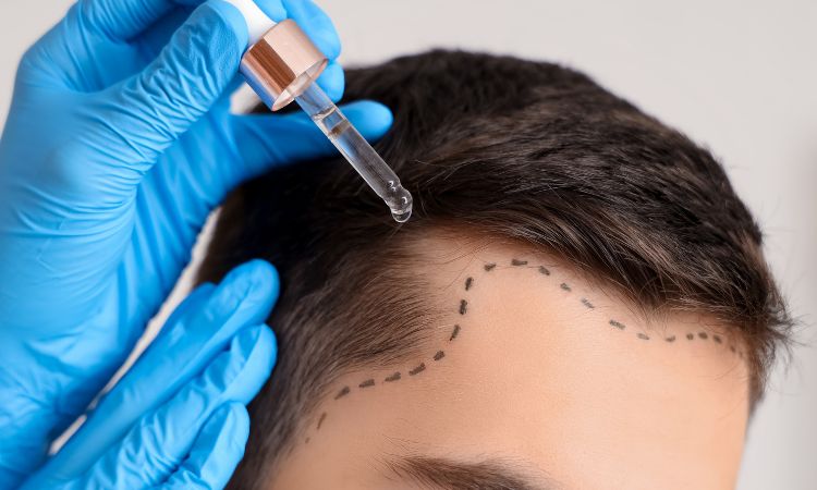 Causas de la pérdida de cabello: cómo abordarlas desde la medicina estética
