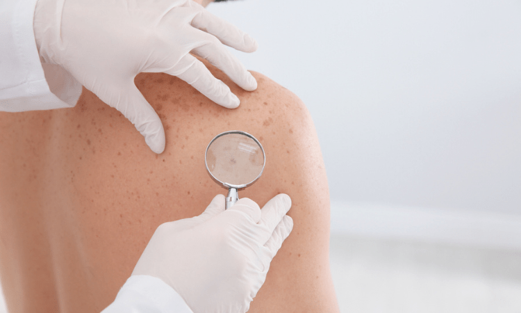 Dermatología oncológica: ¿Cuándo se debe visitar al especialista?